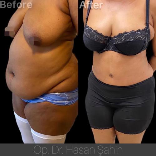 Liposucción Láser Foto antes/después